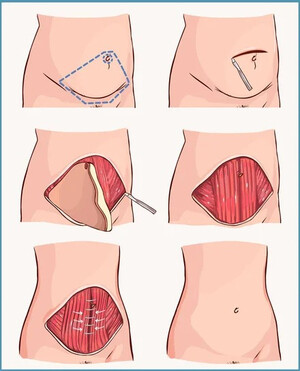 Rimodelimi i Barkut (Abdominoplastika)