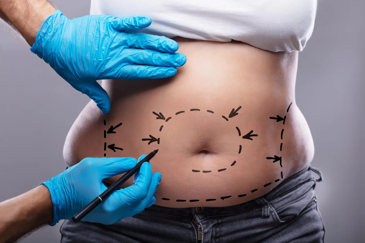 Rimodelimi i Barkut pas Shtatzënisë - Tummy Tuck