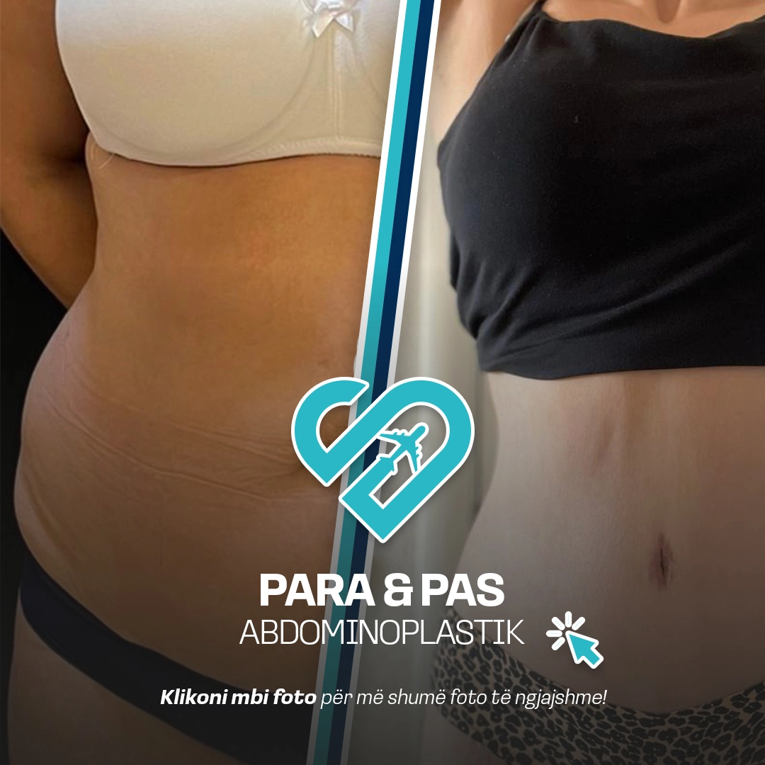 Para & Pas Abdominoplastik