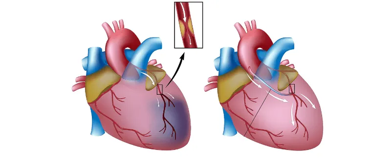 Bypass kardiak vs. stent: Cila është zgjidhja e duhur?