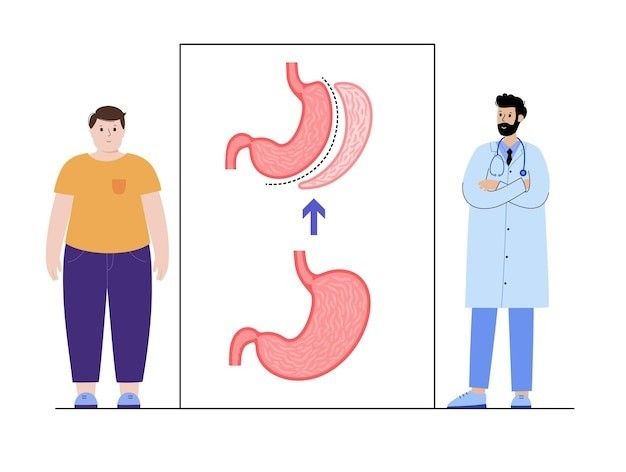 Obeziteti & Operacioni Gastric Sleeve në Turqi si Zgjidhje Afatgjatë