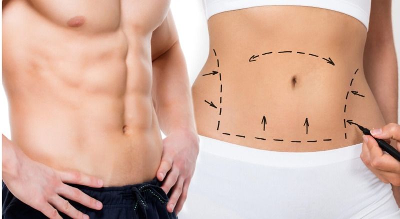Rimodelimi i trupit pas humbjes ekstreme në peshë – Abdominoplastika si zgjidhje