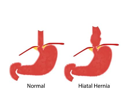 5 Shenjat Që Tregojnë se Mund të Keni Hernie Hiatale