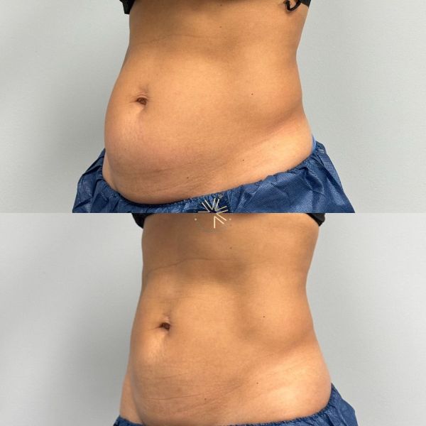 Abdominoplastika: Bark më i Rrafshët dhe Muskuj më të Fortë
