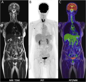 Çfarë është PET-MRI, për cfarë na ndihmone dhe si ndikon në shëndetin tonë?